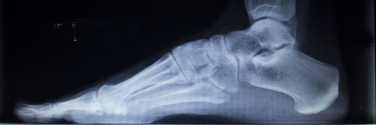 X-ray orthopedic medical CAT scan of painful foot injury in traumatology hospital clinic showing load weight bearing.